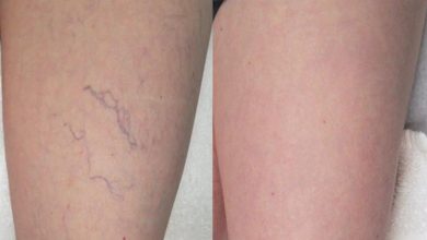 Manage Spider Veins