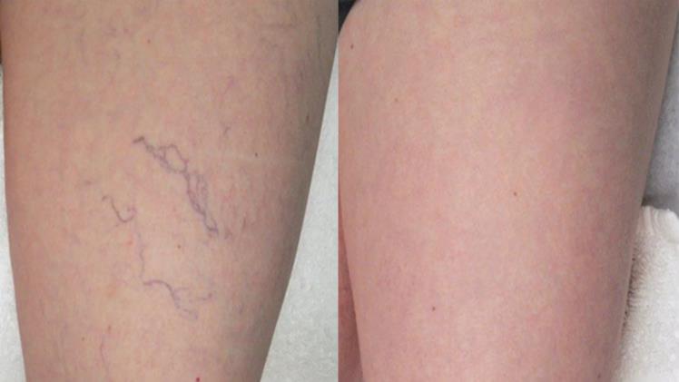 Manage Spider Veins